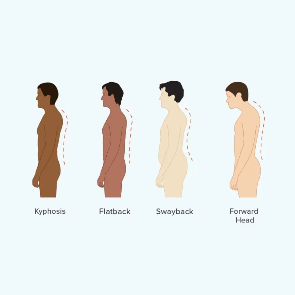 Illustration showing four types of special body shapes: kyphosis, flatback, swayback, and forward head alignment.